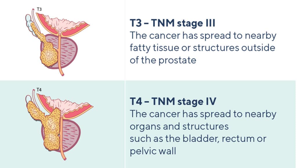 Types of Advanced Prostate Cancer 2 Advanced cancer: TNM stages III or IV